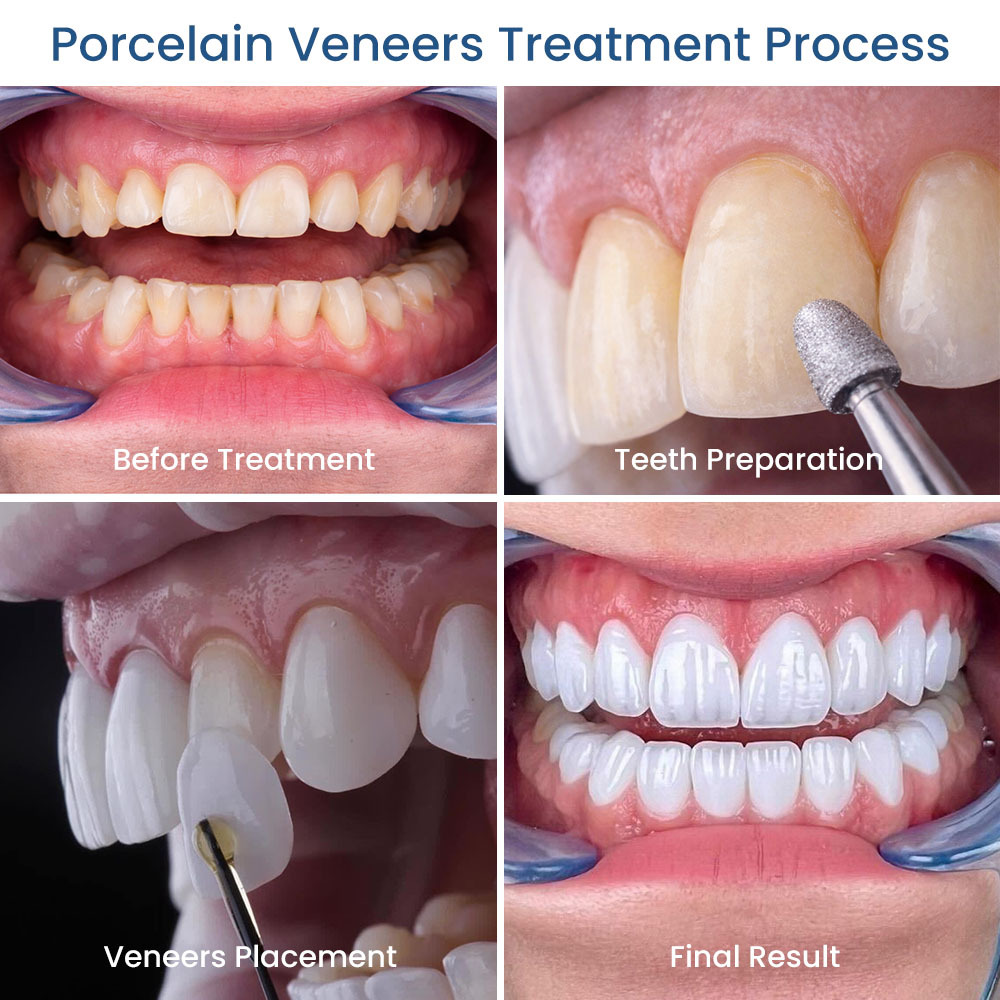 Porcelain Veneers Treatment Process Glendale, NY
