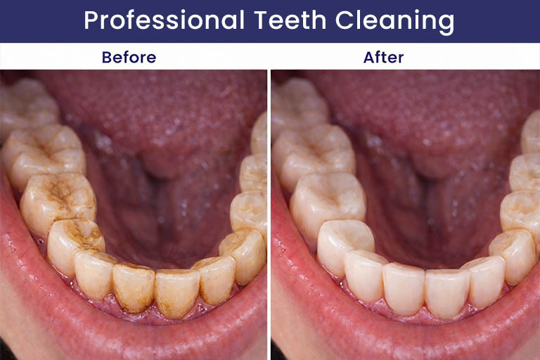 Before and after professional teeth cleaning showing tartar buildup on the inner lower teeth and the results after dental scaling and polishing