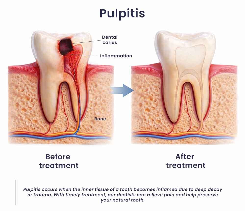 Pulpitis Treatment Glendale, NY