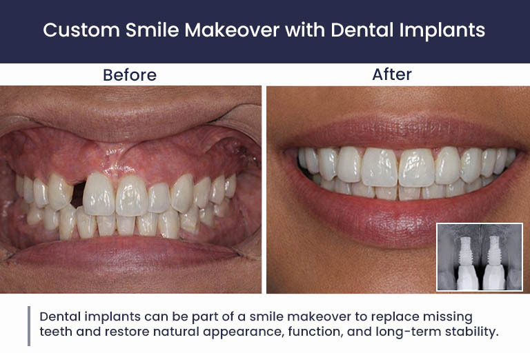 Smile Makeover Dental Implants Before After Atlas Park Dental