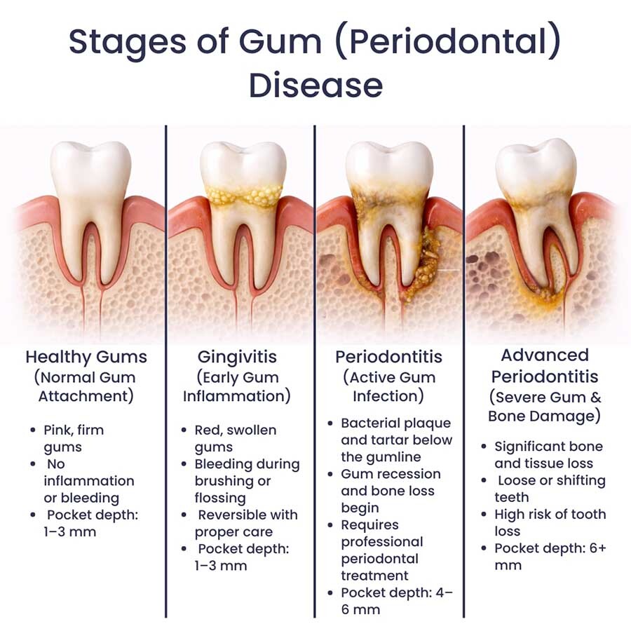 Illustration showing the stages of periodontal disease from healthy gums to advanced periodontitis with bone loss