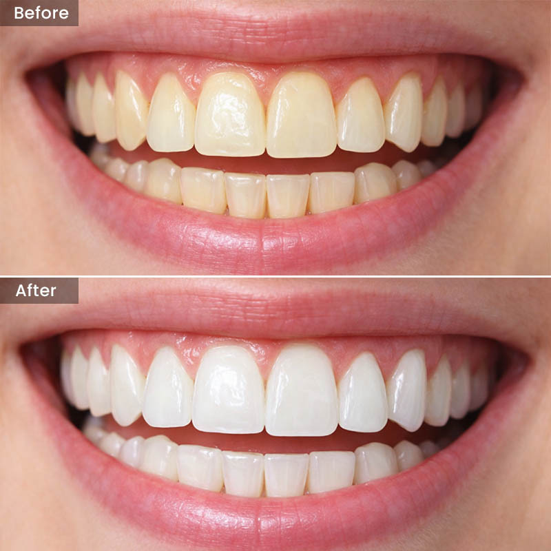 Teeth Whitening Before After Results Glendale Queens, NY