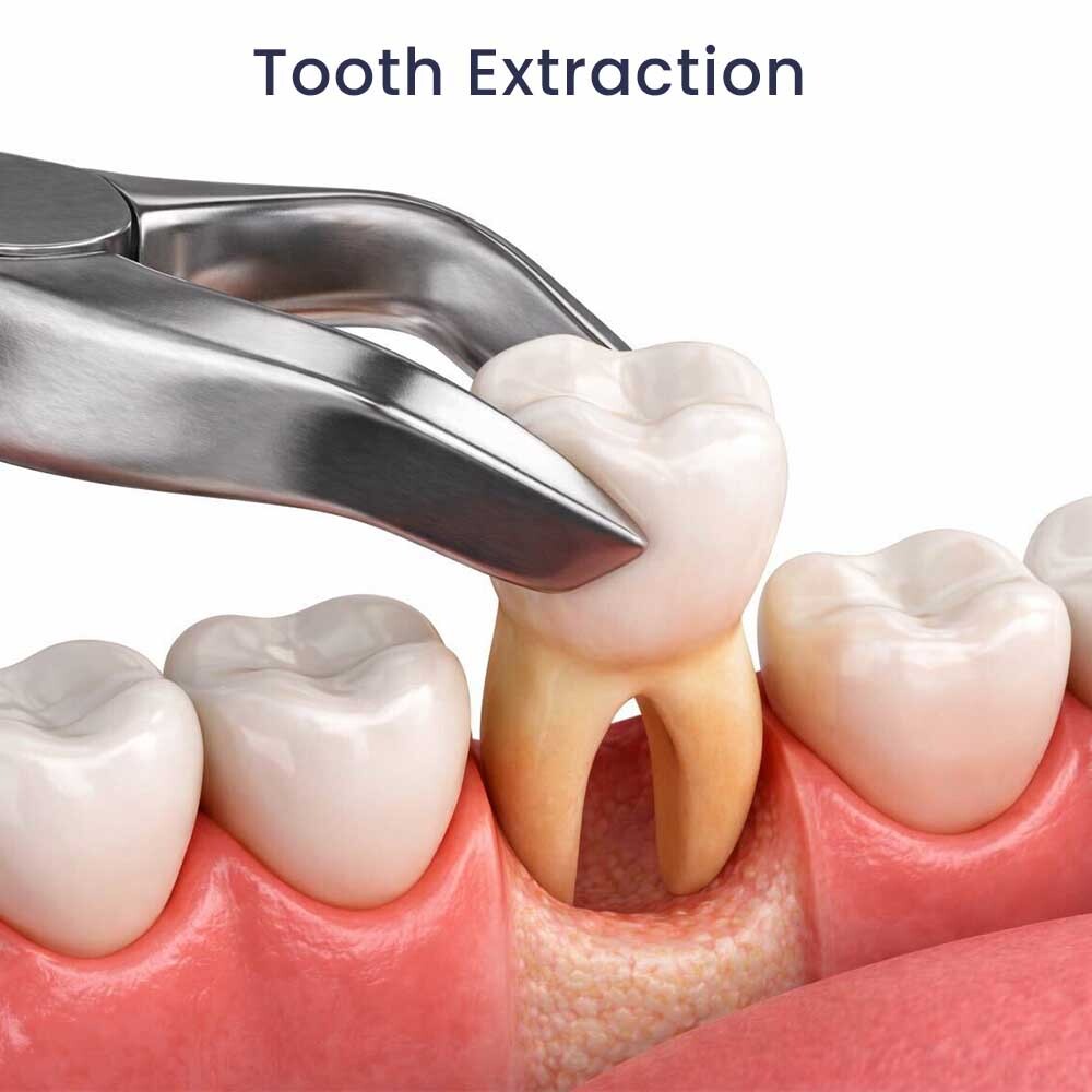 Tooth Extraction Glendale, NY 11385