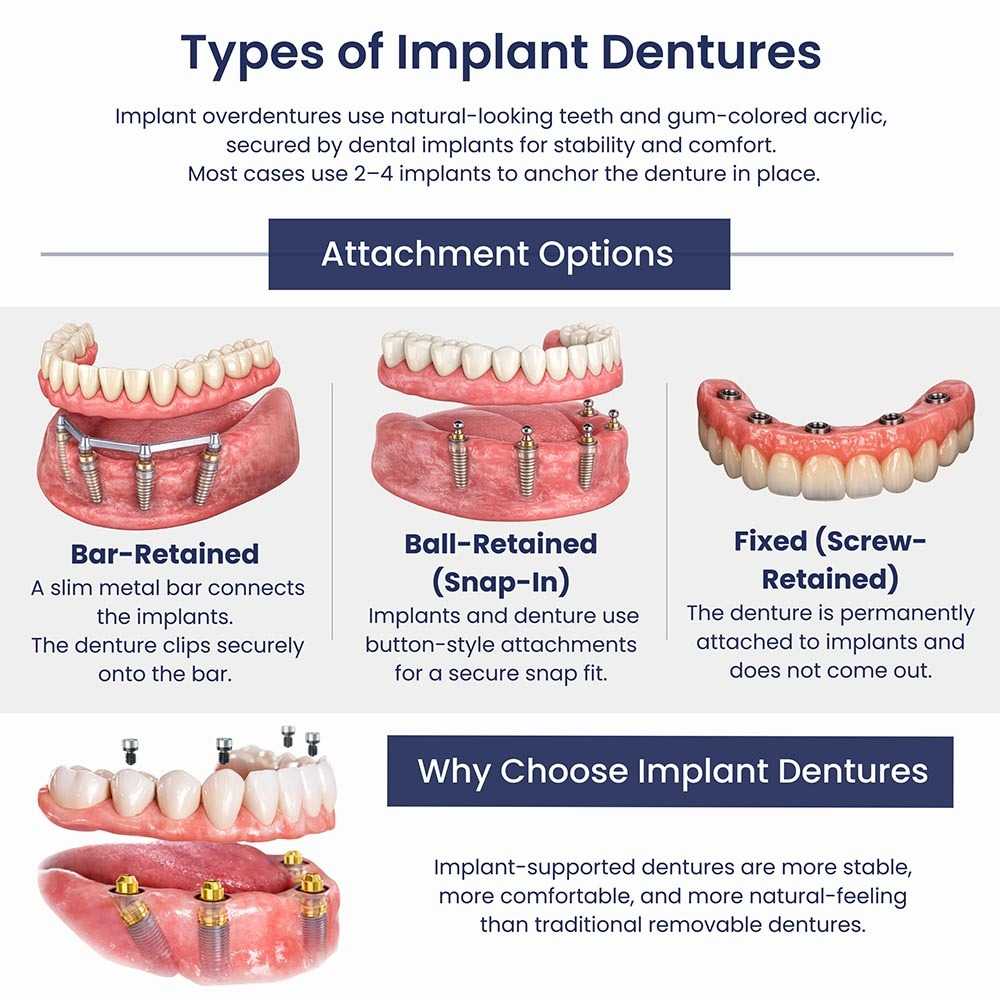 Types of implant dentures showing bar-retained, ball-retained, fixed screw-retained, and All-on-4 full arch options at Atlas Park Dental in Glendale, Queens.